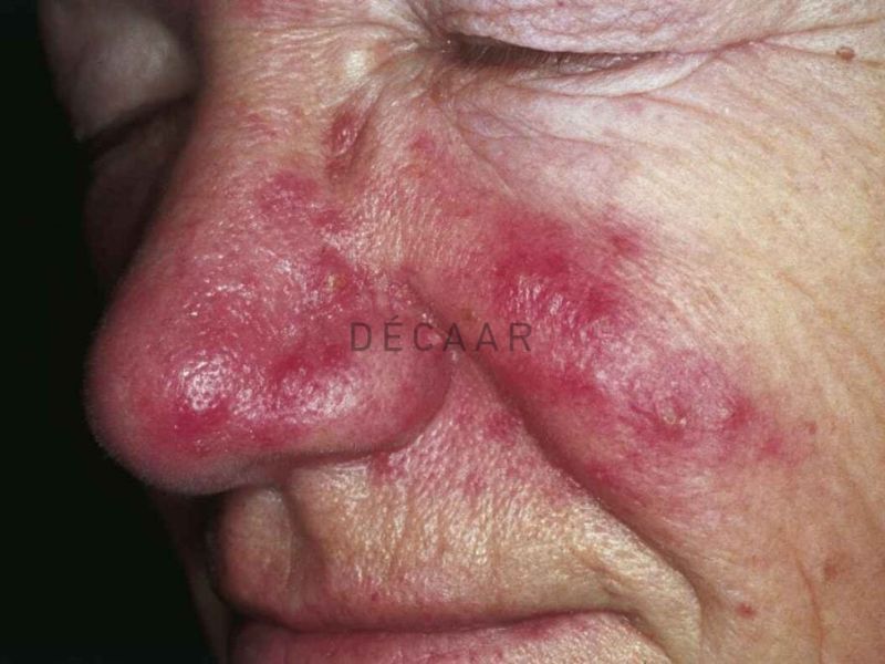 Trứng cá đỏ ở giai đoạn muộn